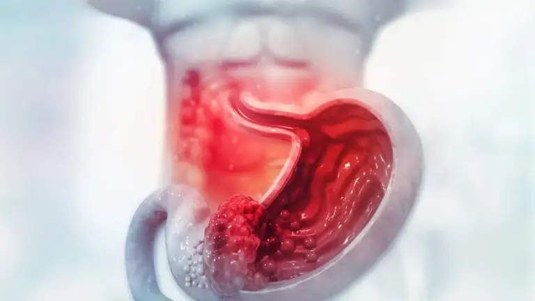 Como É a Cirurgia de Câncer No Estômago?