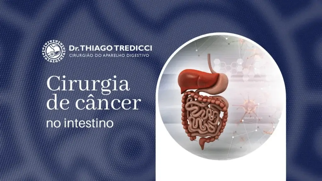 Cirurgia de Câncer no Intestino